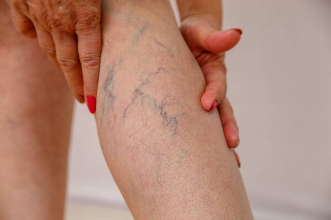 Signs of varicose veins