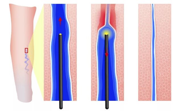 Endovasal electrical cloagulation
