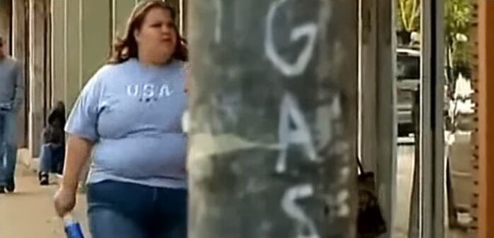 Obesity - the cause of varicose veins