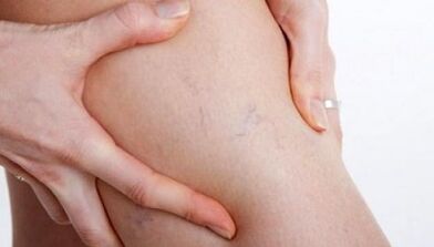 How varicose veins manifest themselves on the legs