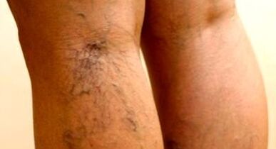 effective methods of treating varicose veins