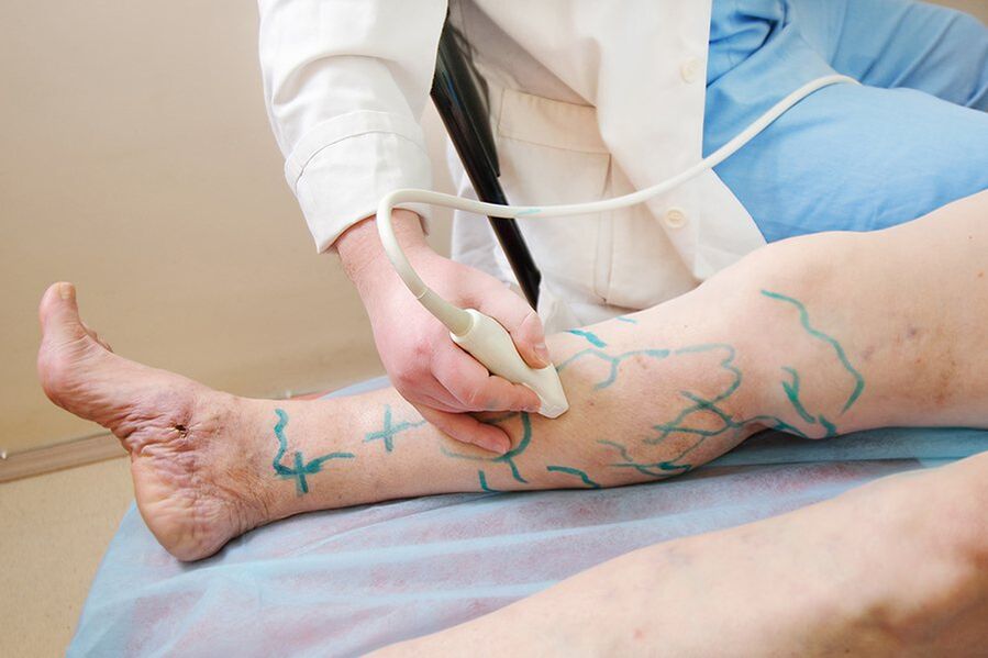 Preparation for miniphlebectomy – marking the perforators of the leg, conducting an ultrasound examination