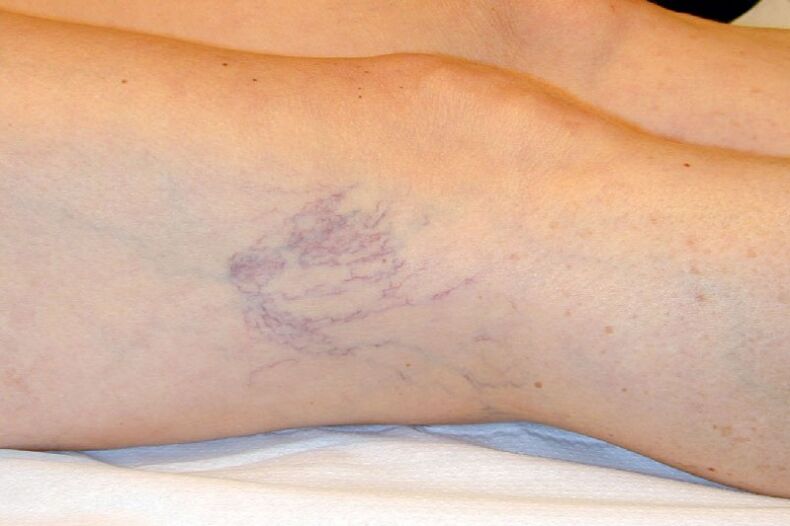 Stage C1 – reticular veins approximately 1 mm in diameter