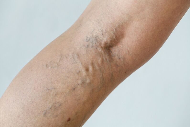 Stage C2 – Popliteal varicose veins (Thierry perforator veins) and reticular veins