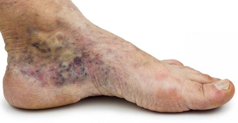 Stage C4c – crown of foot, phlebitis in the middle