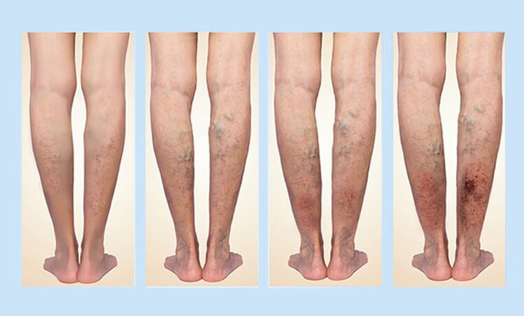 Stadiums of varicose veins